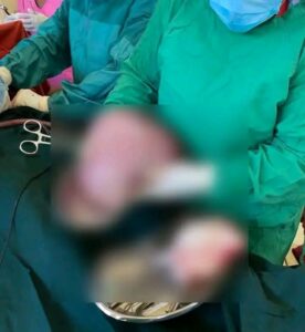 40 UEAR OLD WOMAN UNDERGOES SUCCESSFUL OPERATION AT SENANGA HOSPITAL
